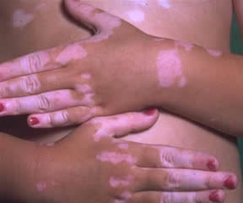Hogyan lehet fehéríteni a bőrt a vörös foltoktól. Szakmai eljárások