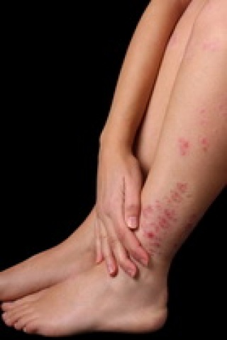 Atópiás dermatitisz tünetei és kezelése