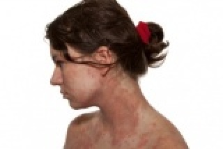 az arcbőrről lehámozva vörös folt maradt gyógymódok pikkelysömör népi gyógymódok