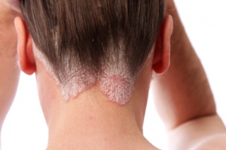 hogyan lehet gyógyítani a pikkelysömör bőrbetegségét