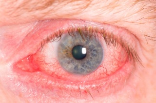 szemproblémák és betegségek myopia az ájurvéda kezelésében