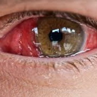 Hipertónia szeme fotó - Mi az a magas vérnyomás?