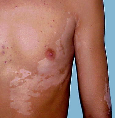 vitiligo bőrbetegség