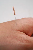 alkalmazható-e az akupunktúra magas vérnyomás esetén