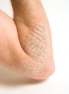 Pikkelysömör vagy seborrhoeás dermatitisz? Hasonló, de nem ugyanaz