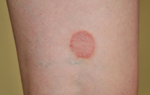 psoriasis vulgaris jelentése kerek folt a bőrön piros peremű fotóval