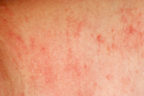 gyulladásos bőrbetegségek övsömör fertőzés