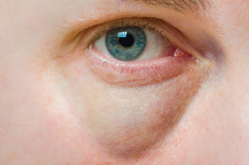 Vörös foltok az arcon a szem alatti duzzanattal. Gyakori megbetegedések