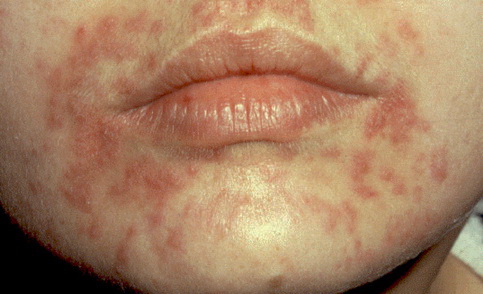 betegség az arcon hámlás és hámlás vörös foltjai