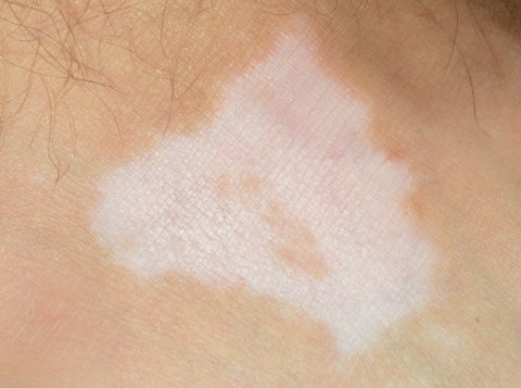 Vitiligo, avagy mit kell tudnunk a kórképről a Vitiligo világnapján?