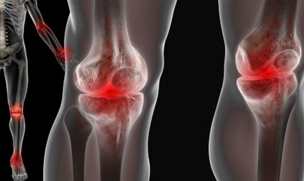Futókat érintő lábfájdalmak és kezelésük | Futásról Nőknek