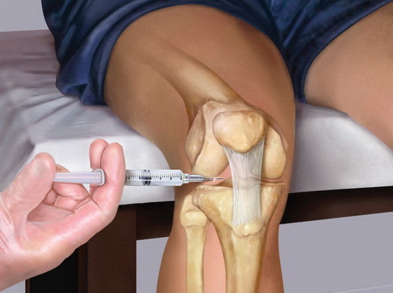 hialuronsav artrózis kezelés láb deformáló artrózisa és kezelése
