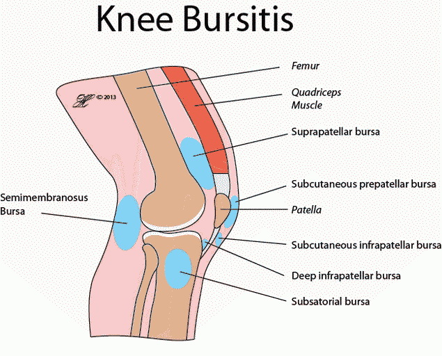 térd tünetek pretetellaris bursitis és kezelése