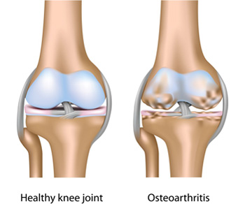 a térd osteoarthritisének megelőzése