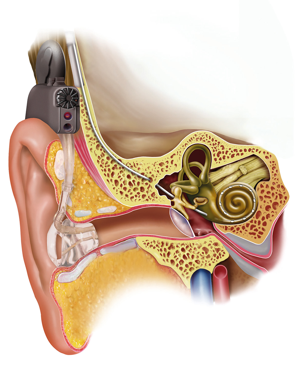 Барабанной перепонкой и внутренним ухом. Кохлеарная имплантация строение уха. Серная пробка на барабанной перепонке. Наружный отит барабанная перепонка.