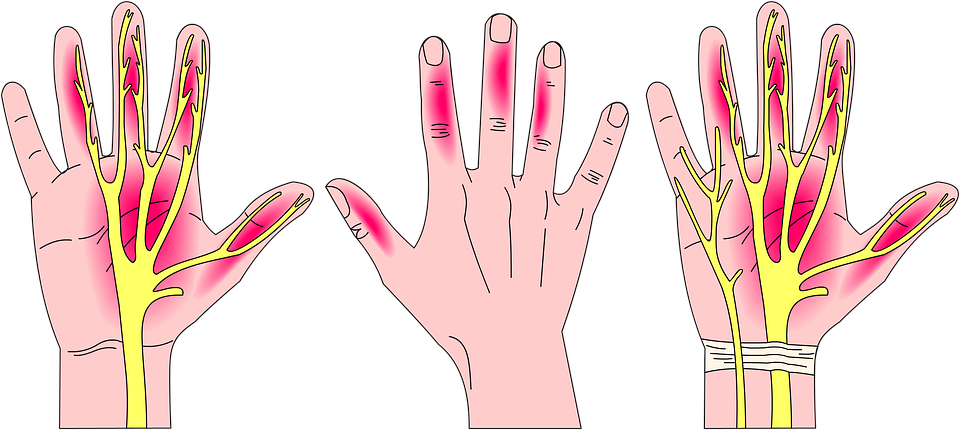 Zsibbadás a kézben – az alagút szindróma tünetei