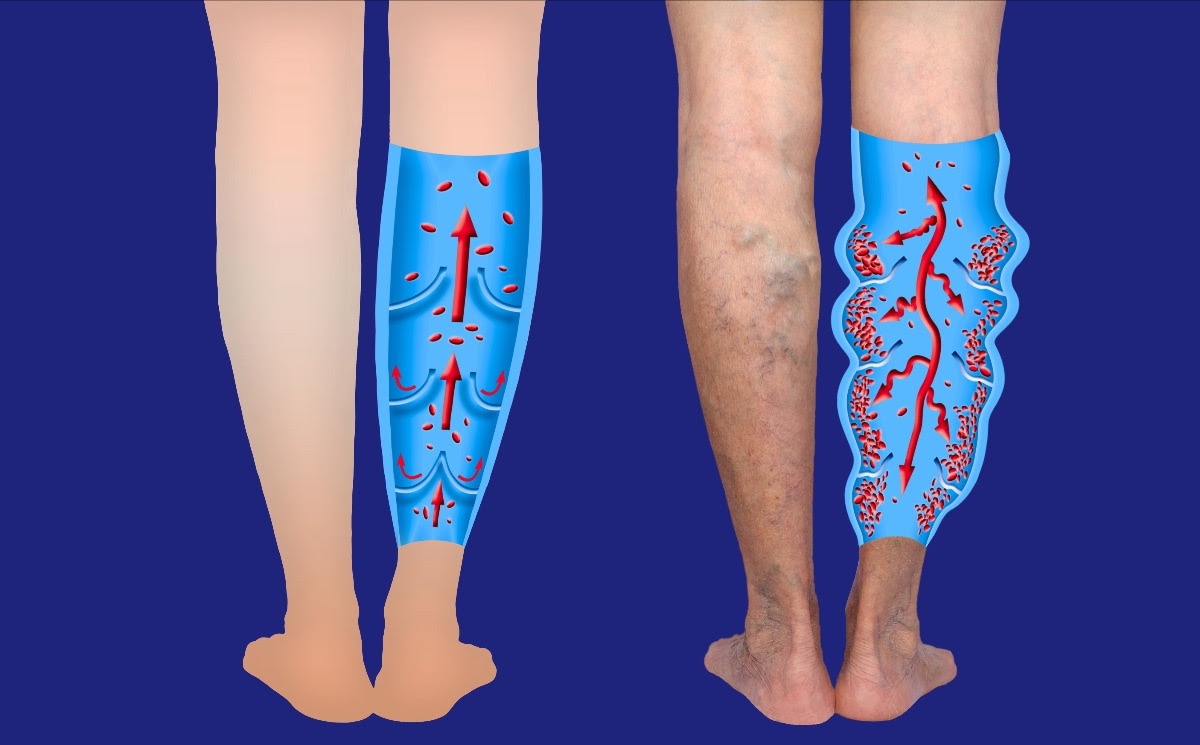a lábak nehézsége visszeres kezeléssel krémek a visszér első jeleire