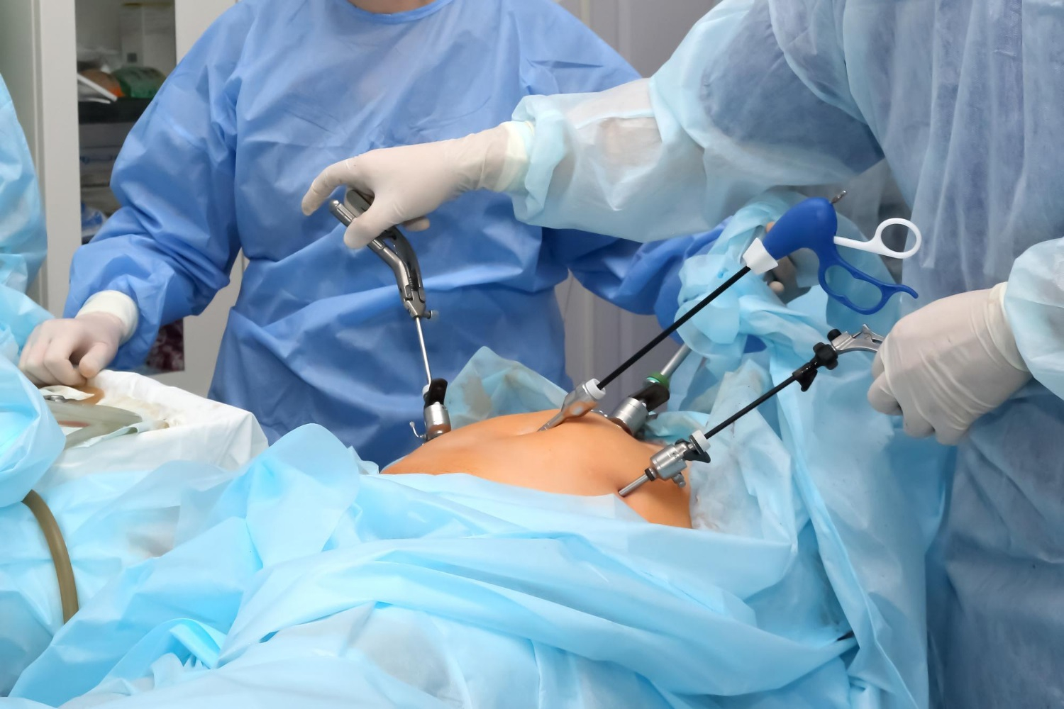 Laparoszkópos műtét