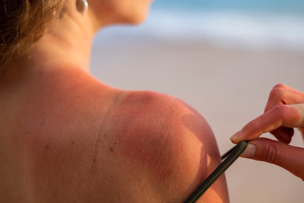A komoly UV-terheléssel nő a bazálsejtes karcinóma kockázata. (Forrás: freepik.com)